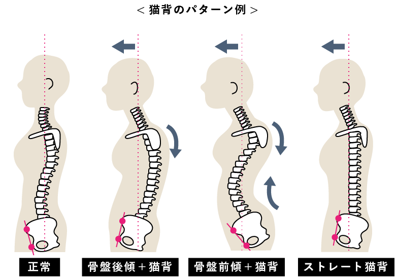 猫背　パターン