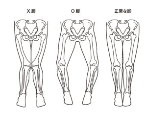 O脚X脚