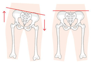 骨盤歪み