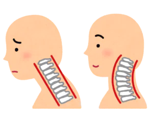 sick_straight_neck